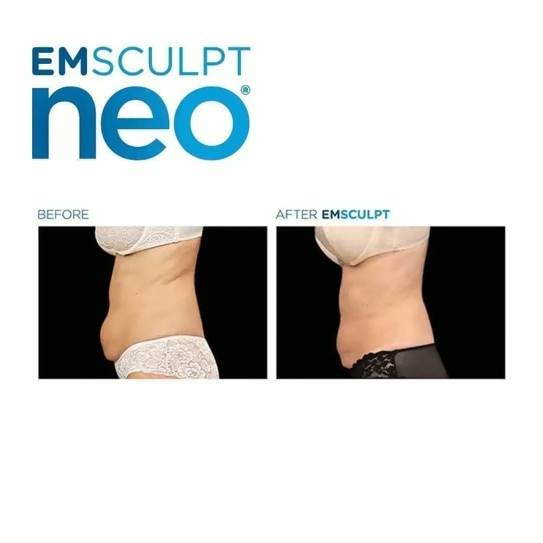 Emsculpt Neo before and after — Abdomen · side profile